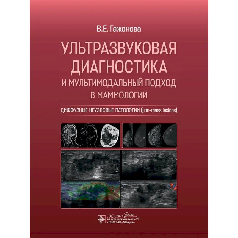 Ультразвуковая диагностика и мультимодальный подход в маммологии. Диффузные неузловые патологии Ультразвуковая диагностика и мультимодальный подход в маммологии. Диффузные неузловые патологии