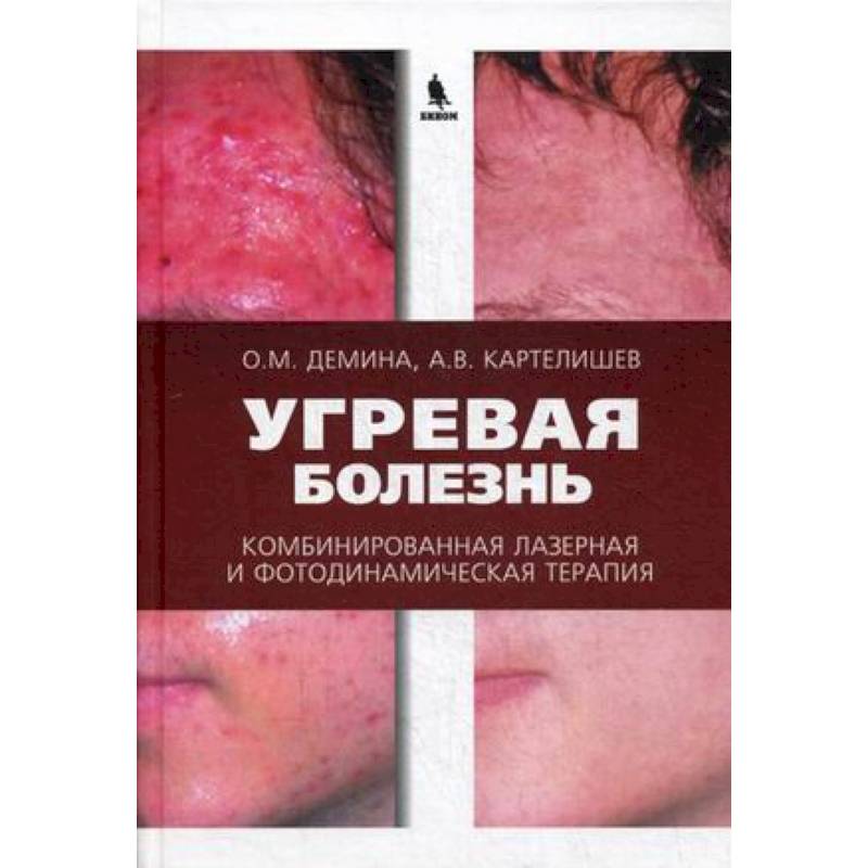 Угревая болезнь. Комбинированная лазерная и фотодинамическая терапия Угревая болезнь. Комбинированная лазерная и фотодинамическая терапия
