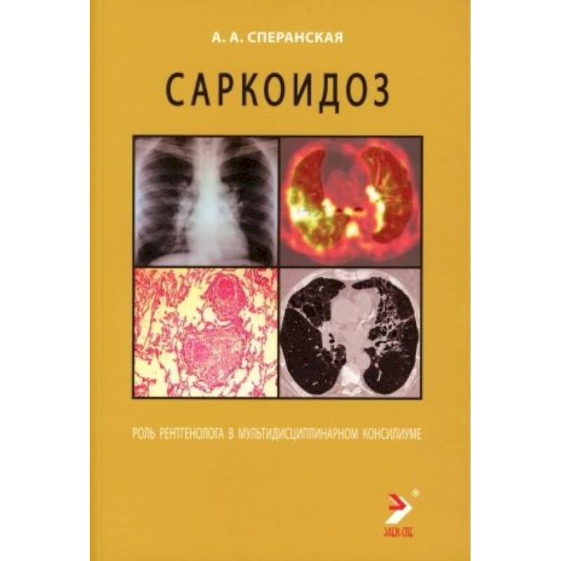 Саркоидоз. Роль ренгенолога в мультидисциплинарном консилиуме Саркоидоз. Роль ренгенолога в мультидисциплинарном консилиуме