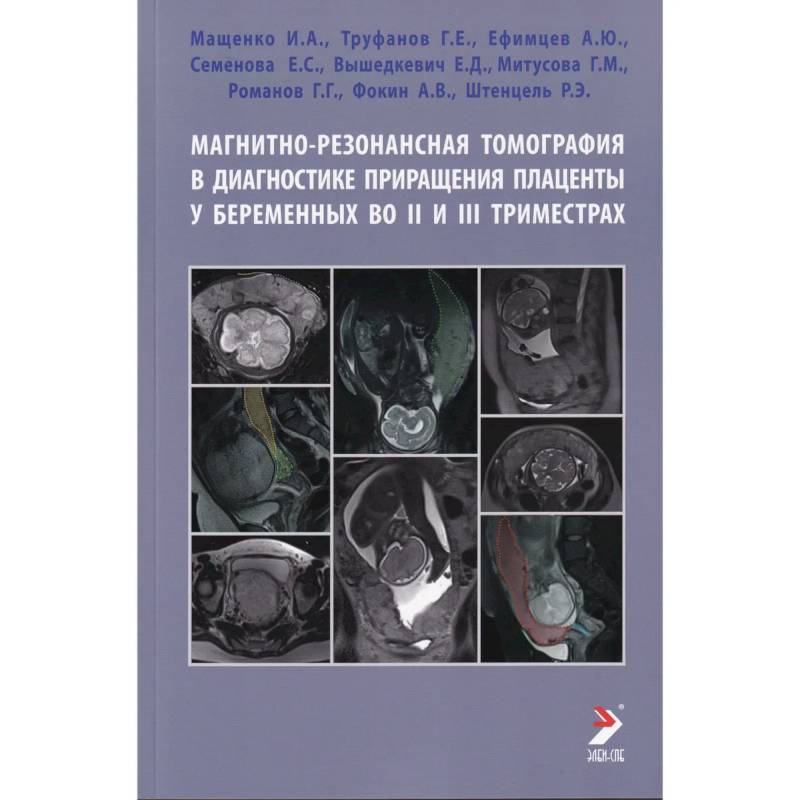 Магнитно-резонансная томография в диагностике приращения плаценты у беременных во II и III триместрах Магнитно-резонансная томография в диагностике приращения плаценты у беременных во II и III триместрах