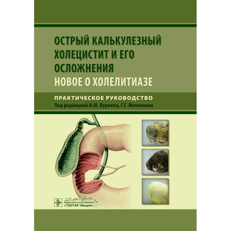 Калькулезный холецистит что это. Острый калькулезный холецистит. Холецистит и его осложнения. Осложнения острого калькулезного холецистита. Гангренозный холецистит.