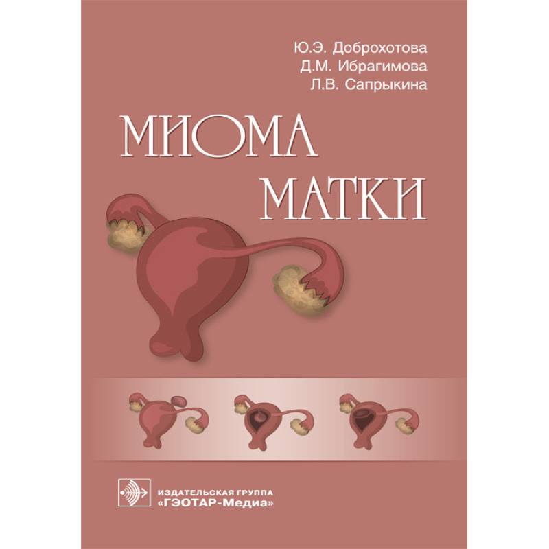 Миома матки Миома матки